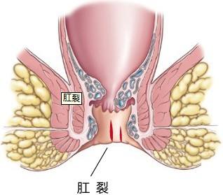 肛裂.jpg