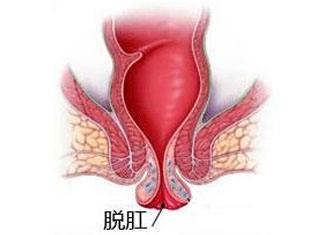 肛门坠胀.jpg