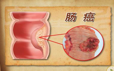 广州东大医院:慢性结肠炎是否会诱发癌变?